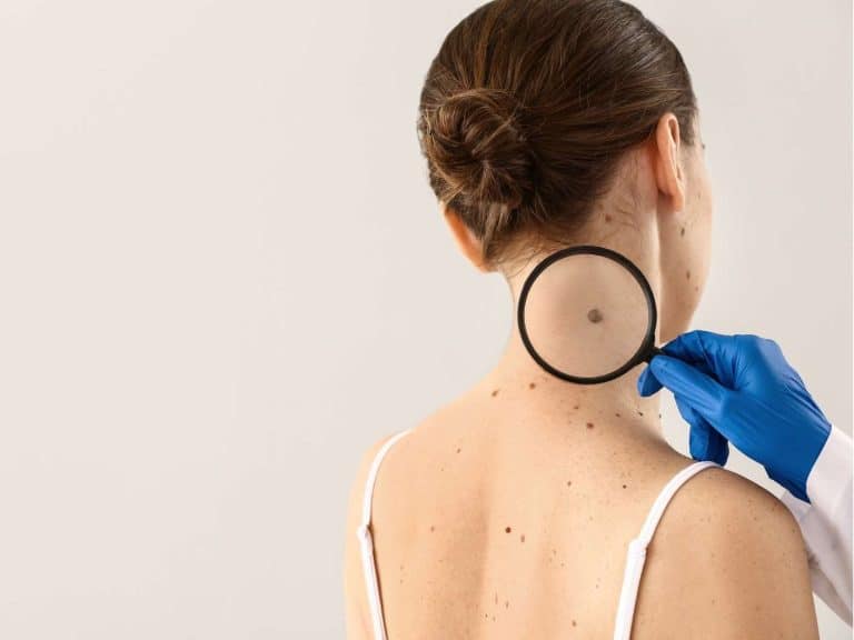 birthmark-mole-on-the-neck-meaning-for-females-males