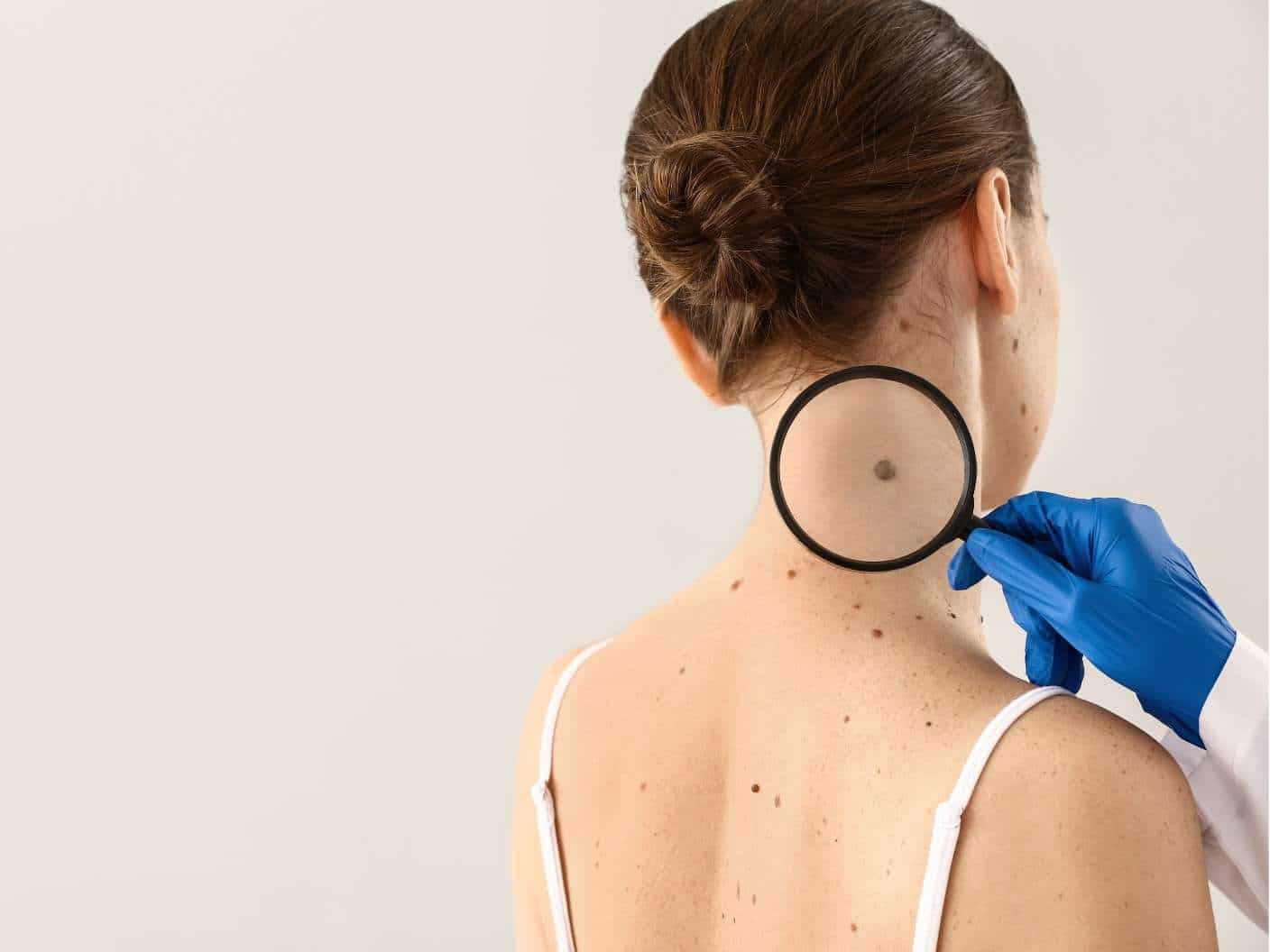 birthmark-mole-on-the-neck-meaning-for-females-males