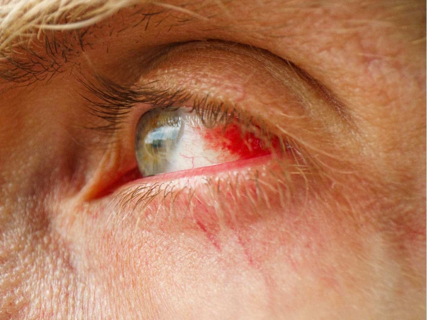 spiritual-meaning-of-broken-blood-vessel-in-the-eye-left-right