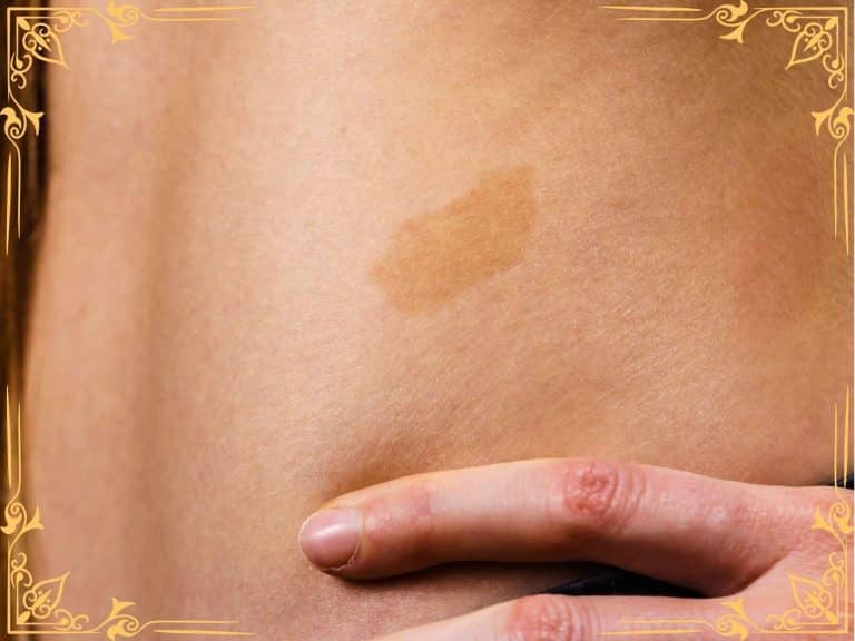 meanings-of-birthmark-on-buttock-for-females-males