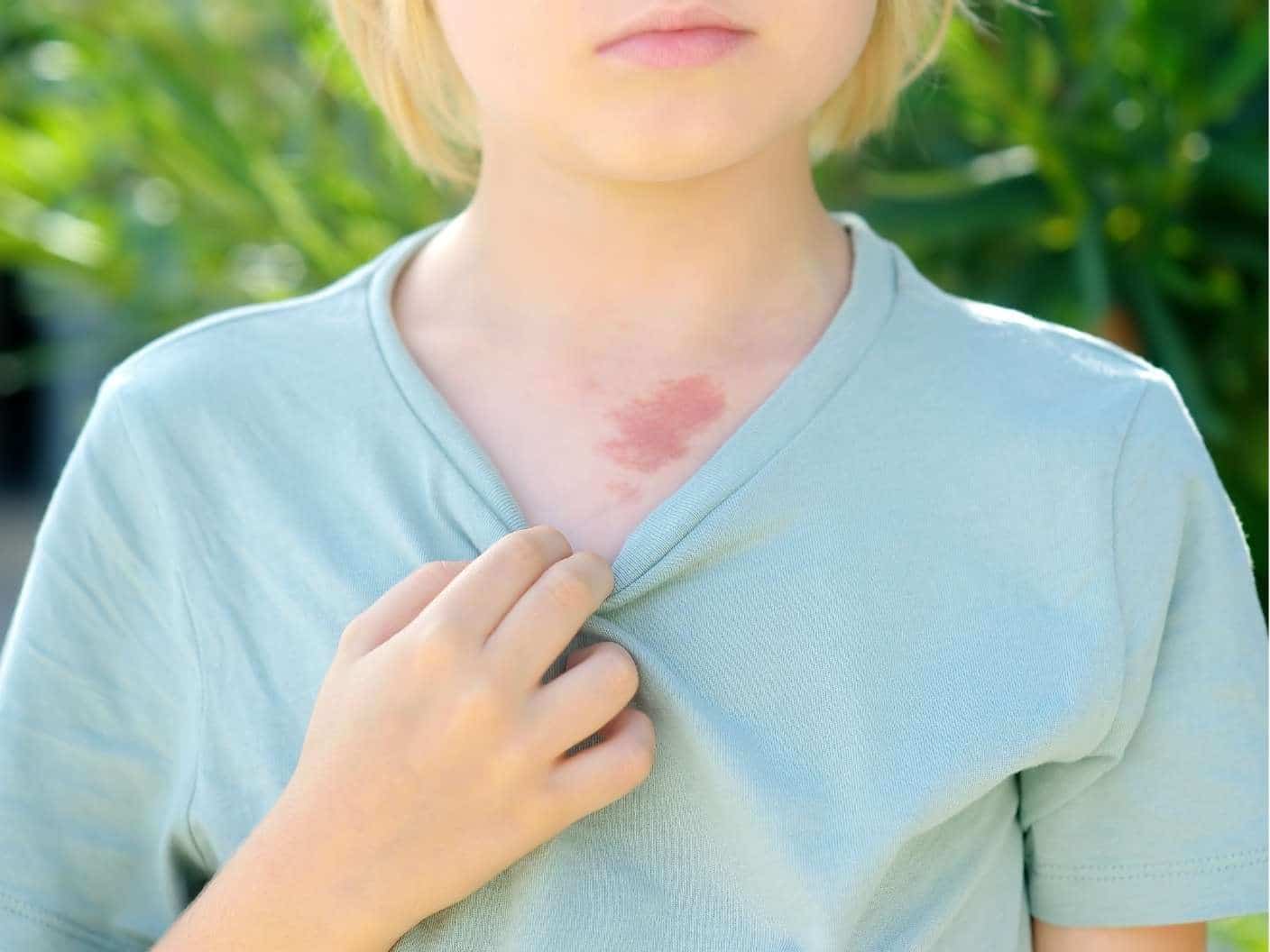 royal-birthmark-meanings-superstitions-traits-folklore
