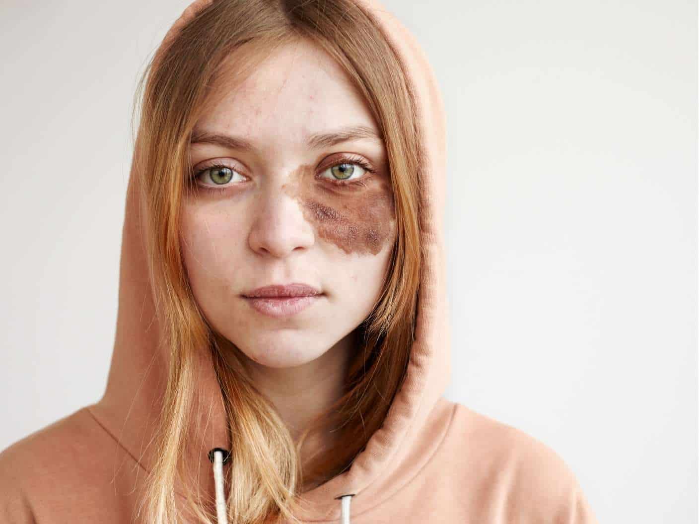 spiritual-meaning-of-birthmark-in-eye-left-right